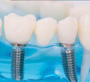 implantes dentátios