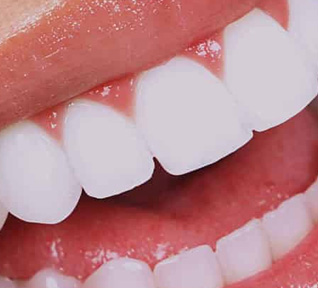 Lentes de Contato odontologia
